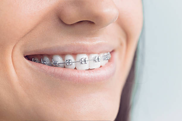 Dental Bonding in Cosmopolis, WA